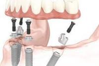 allon6dentalimplantsmexico