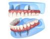 dentalimplantinmexico